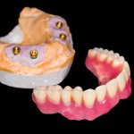 Photo of a complete removable denture on implants