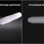 Photo comparison of zirconium and titanium implants