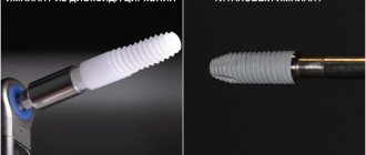 Photo comparison of zirconium and titanium implants