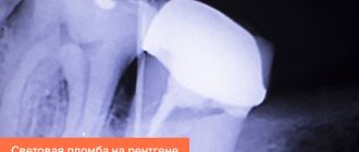 Фото световой пломбы на рентгене