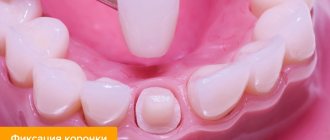 Photo of dental crown installation