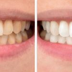 Фото зубов до и после удаления налета