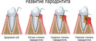 Generalized periodontitis