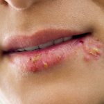 Herpes on the lips - causes, treatment