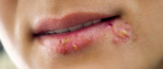 Герпес на губах - причины, лечение