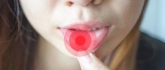 Герпес внутри губы – как лечить: симптомы, причины появления у детей и взрослых