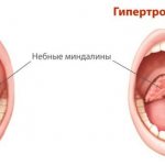 Гипертрофия миндалин