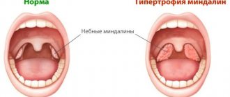 Гипертрофия миндалин