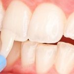 What is deep fluoridation of teeth in children?