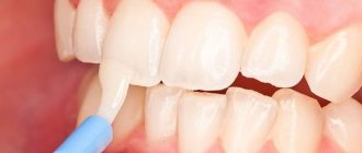 What is deep fluoridation of teeth in children?