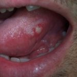 Abscess on the tongue