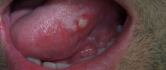 Abscess on the tongue