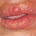 Miescher granulomatous cheilitis