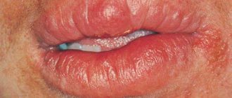 Miescher granulomatous cheilitis