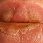 cheilitis