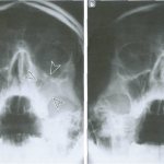 Chronic maxillary sinusitis2.png