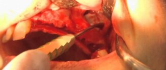 use of aprf to close perforation of the maxillary sinus floor