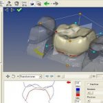 Using Cad Cam System in Dentistry