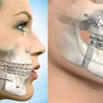 Correcting jaw asymmetry