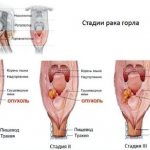 Throat cancer image