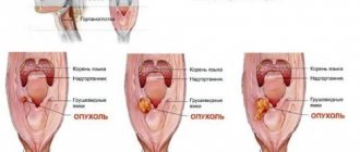 Throat cancer image