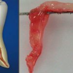 How does a nerve hurt in a tooth? Symptoms and treatment