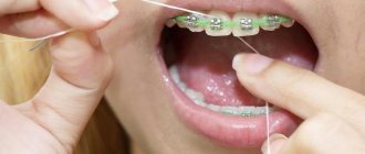 How to floss your teeth with braces