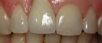 How to get rid of blood from under a tooth crown