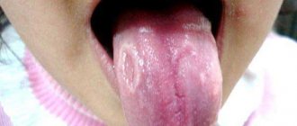 how to treat geographic tongue