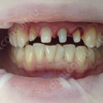 How are teeth ground for crowns? Does it hurt? Why is this done? How is the procedure performed?