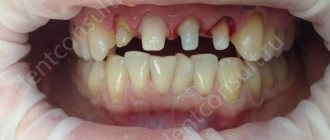 Как обтачивают зубы под коронки, больно ли это, для чего так делают, как проходит процедура?
