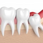 How to understand that a wisdom tooth is growing?