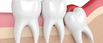 How to understand that a wisdom tooth is growing?