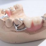 how to remove a clasp prosthesis photo