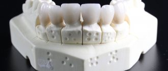 how to put bridges on teeth