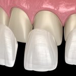 How to place veneers