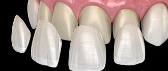 How to place veneers