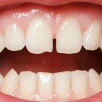 How to close a gap between your front teeth