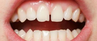 How to close a gap between your front teeth