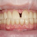 how to remove gap between front teeth