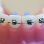 how to care for braces