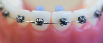 how to care for braces