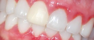 What do inflamed gums look like?