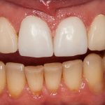 What plastic is used to make temporary crowns?