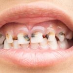 Caries in children