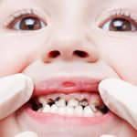 Caries in young children