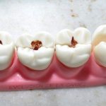 Wisdom tooth caries