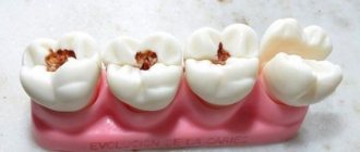 Wisdom tooth caries