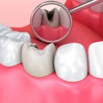 Dental caries