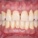 Catarrhal gingivitis